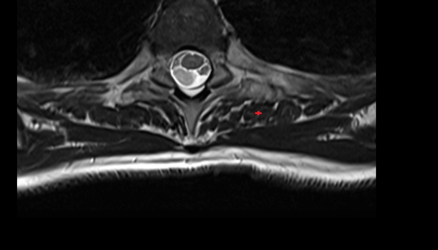 Longissimus muscle  anatomy MRI  axial  image -img-00000-00000