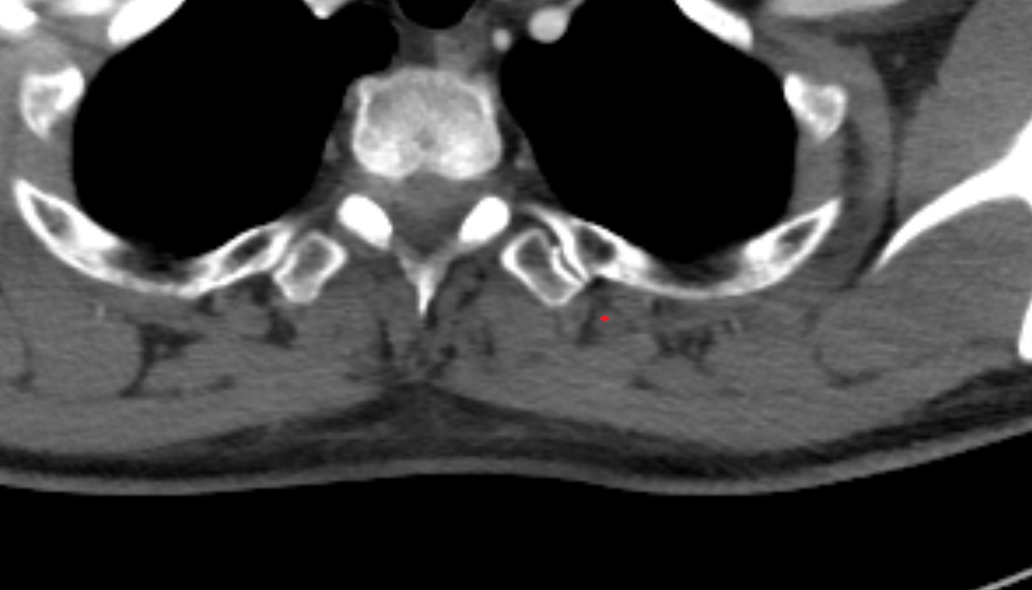 Longissimus muscle muscle  anatomy MRI  axial  image -img-00000-00000