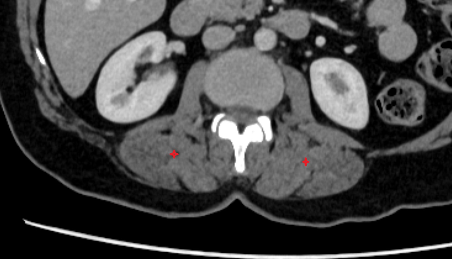 Longissimus thoracis muscle  ct axial  anatomy  image-img-00000-00000
