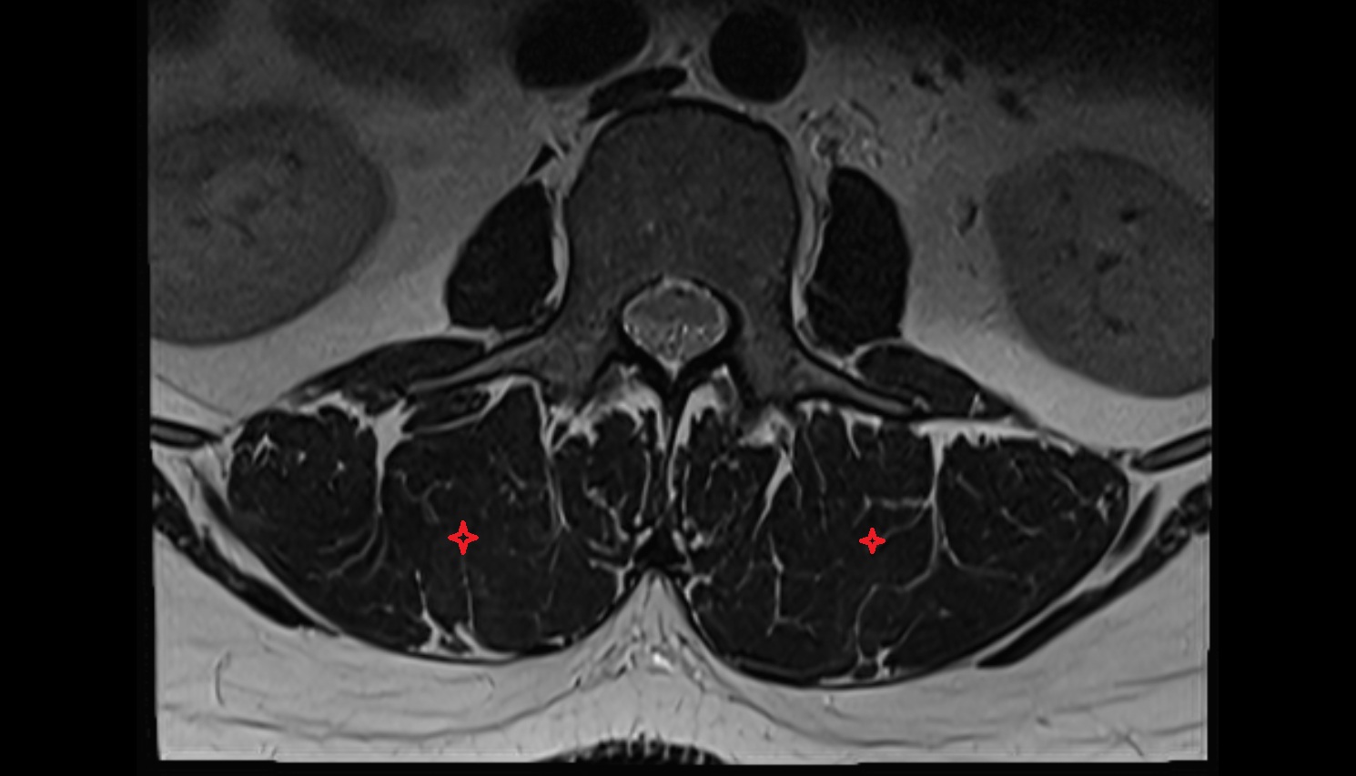 Longissimus thoracis muscle mri  axial  anatomy  image-img-00000-00000