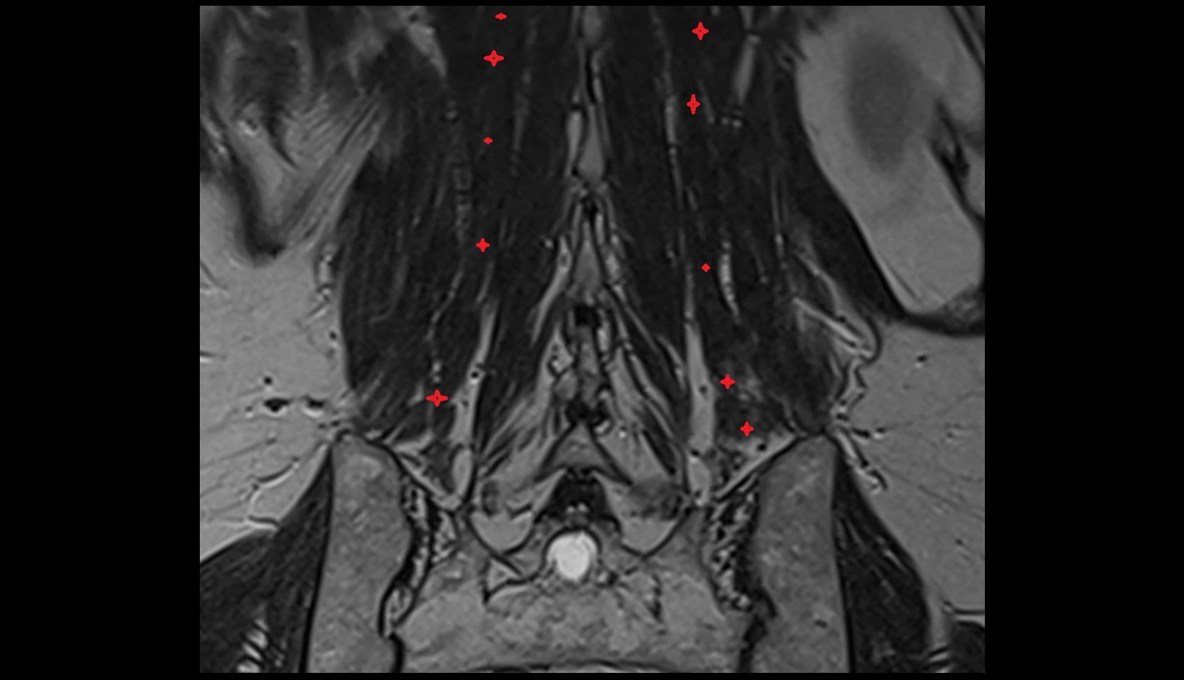 Longissimus thoracis muscle mri coronal image