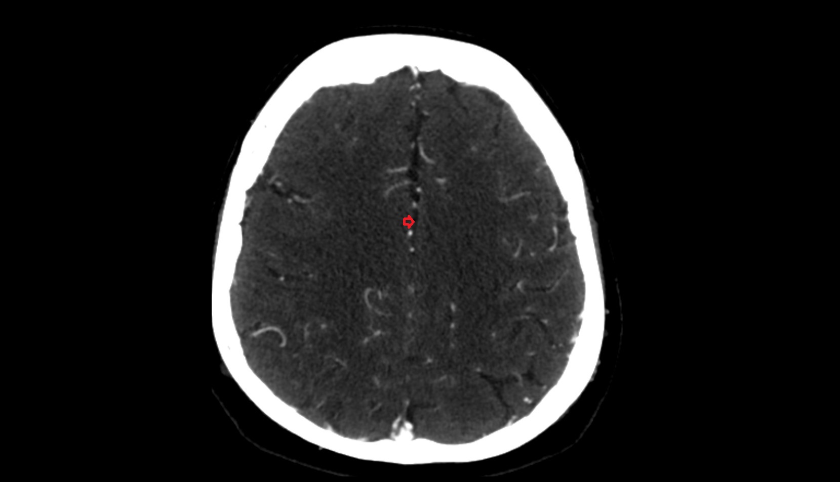 Longitudinal cerebral fissure  CT