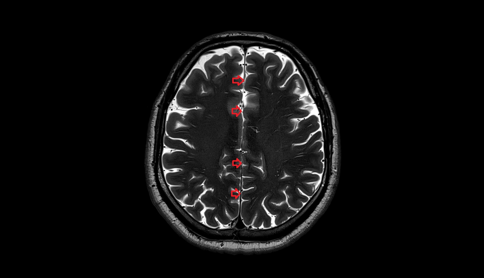 Longitudinal cerebral fissure axial mri image