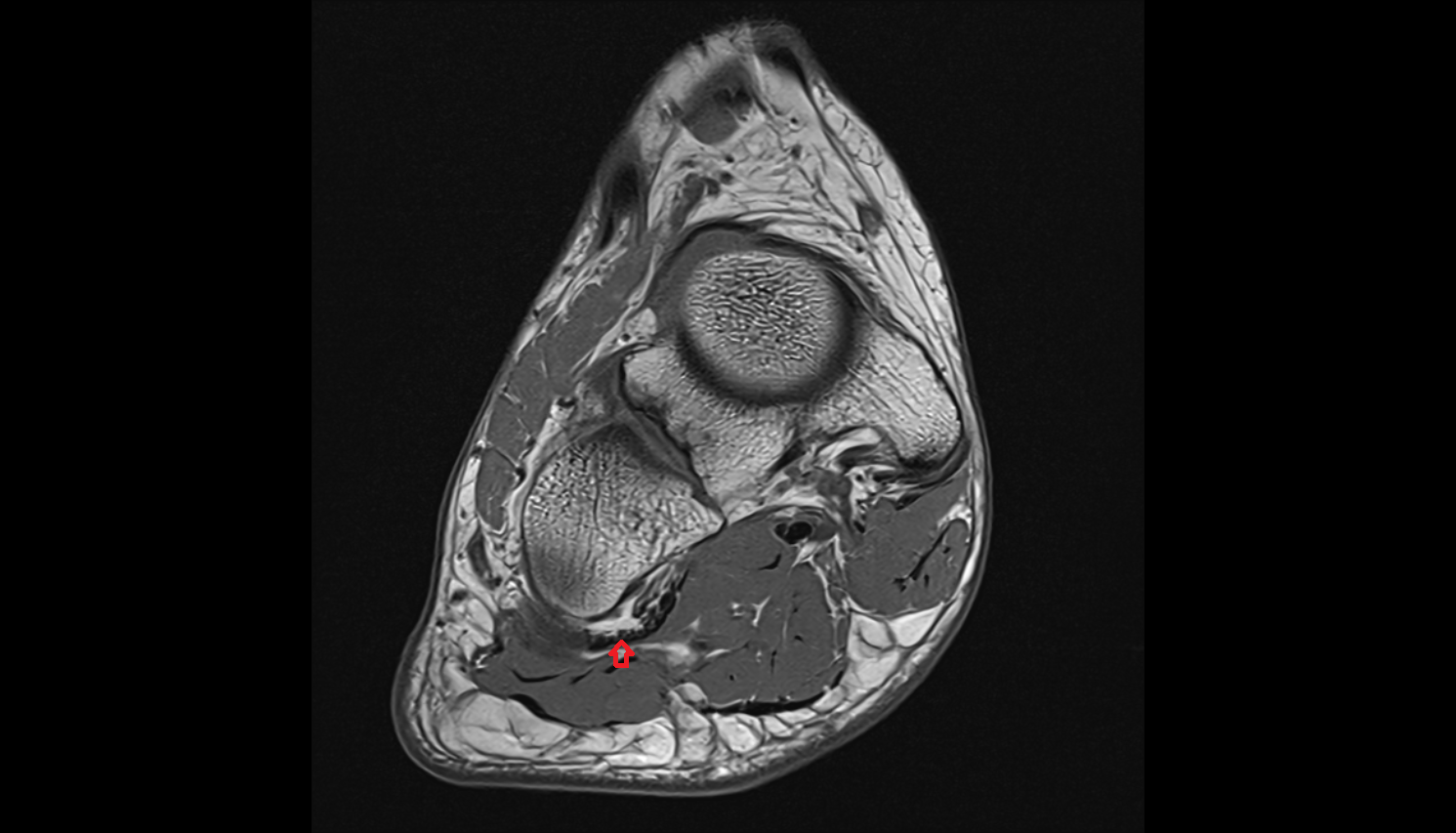 Long plantar ligament axial cross sectional anatomy 3T MRI AI enhanced radiology image-img-00000-00000_00002
