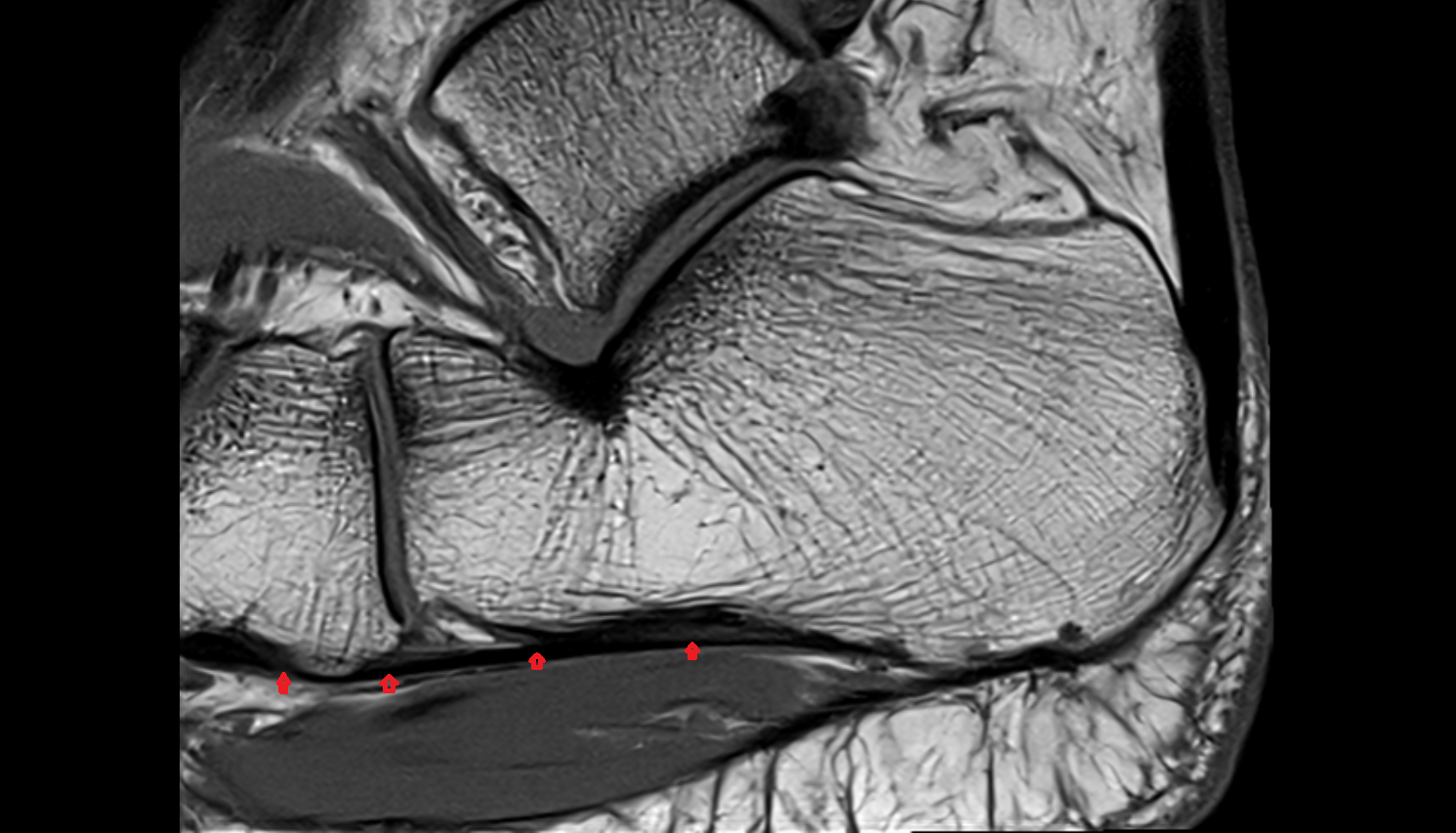 Long plantar ligament sag cross sectional anatomy 3T MRI AI enhanced radiology image-img-00000-00000