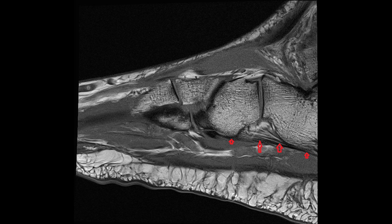 Long plantar ligament sagittal cross sectional anatomy 3T MRI AI enhanced radiology image-img-00000-00000