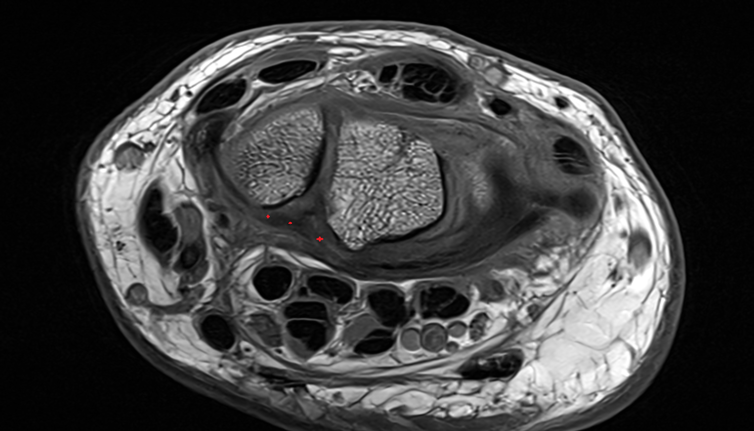 Long radiolunate (radiolunotriquetral) ligament axial cross sectional anatomy 3T MRI AI enhanced radiology image-img-00000-00000