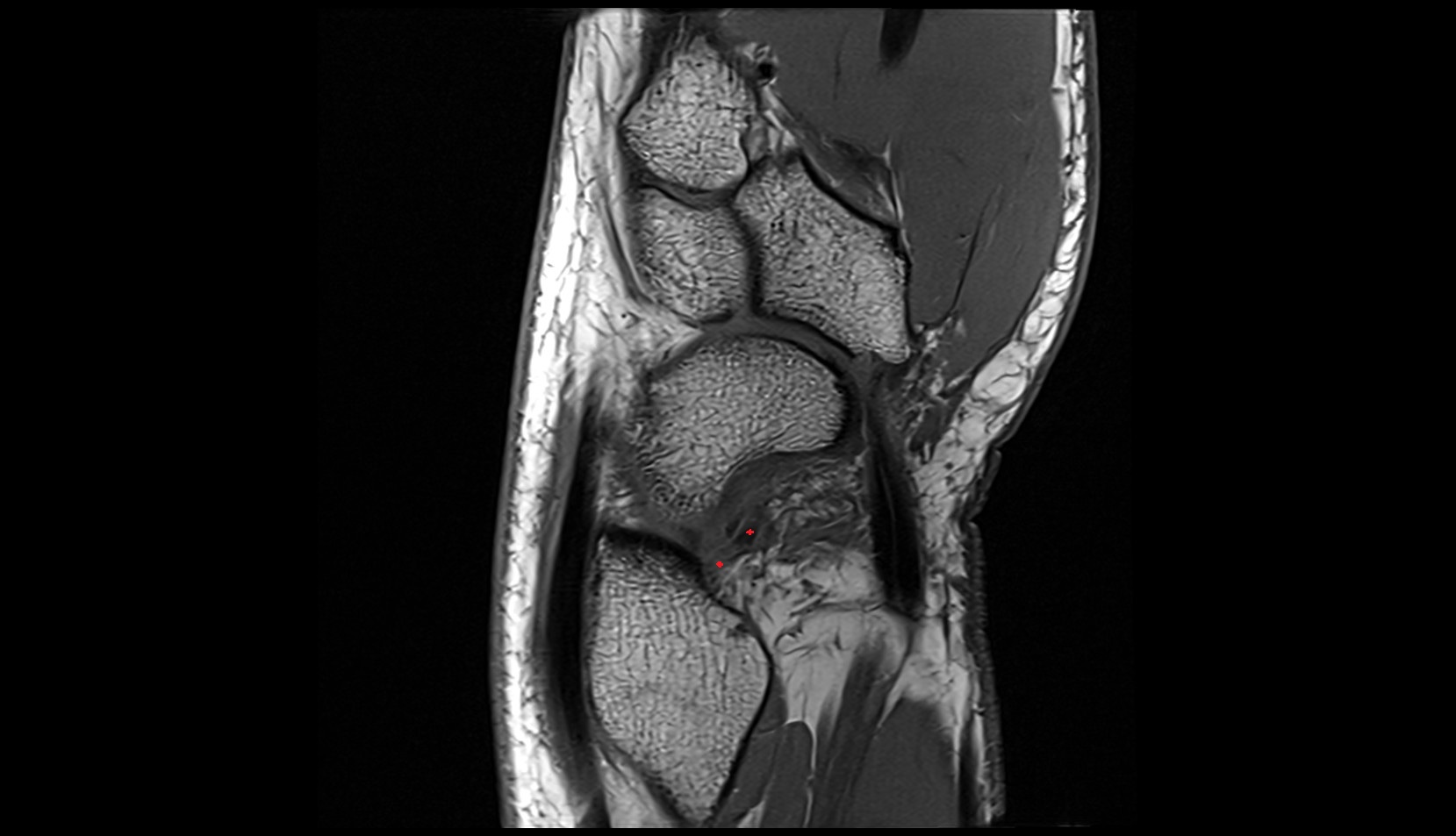 Long radiolunate (radiolunotriquetral) ligament sag mri image 1