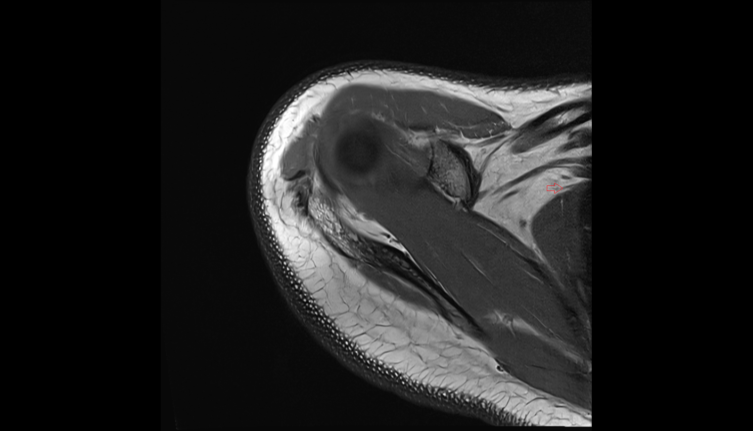 Long thoracic nerve axial cross sectional anatomy 3T MRI AI enhanced radiology image-img-00000-00000