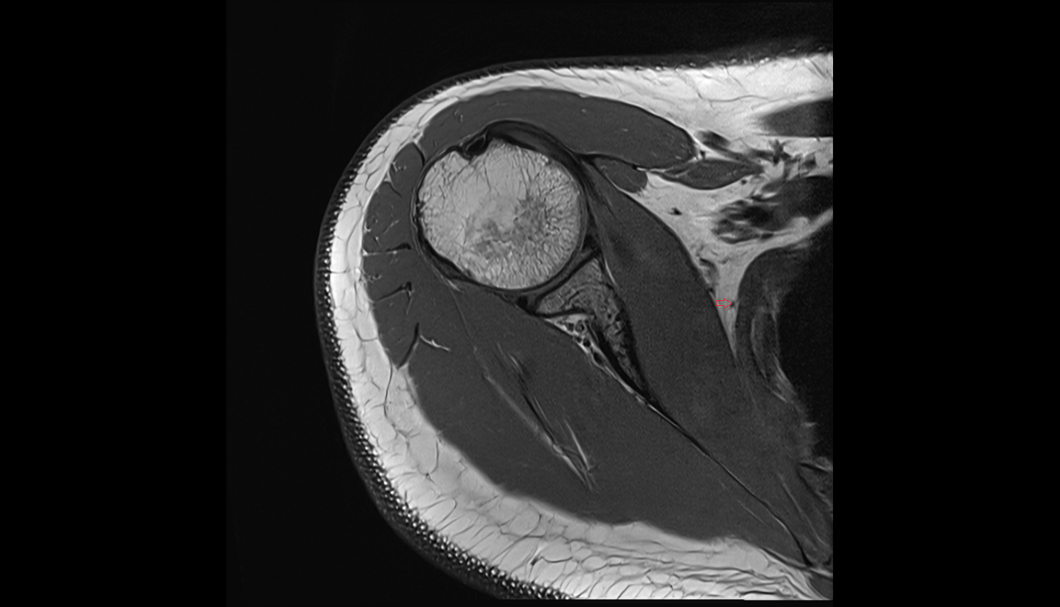 Long thoracic nerve axial cross sectional anatomy 3T MRI AI enhanced radiology image-img-00000-00000_00001
