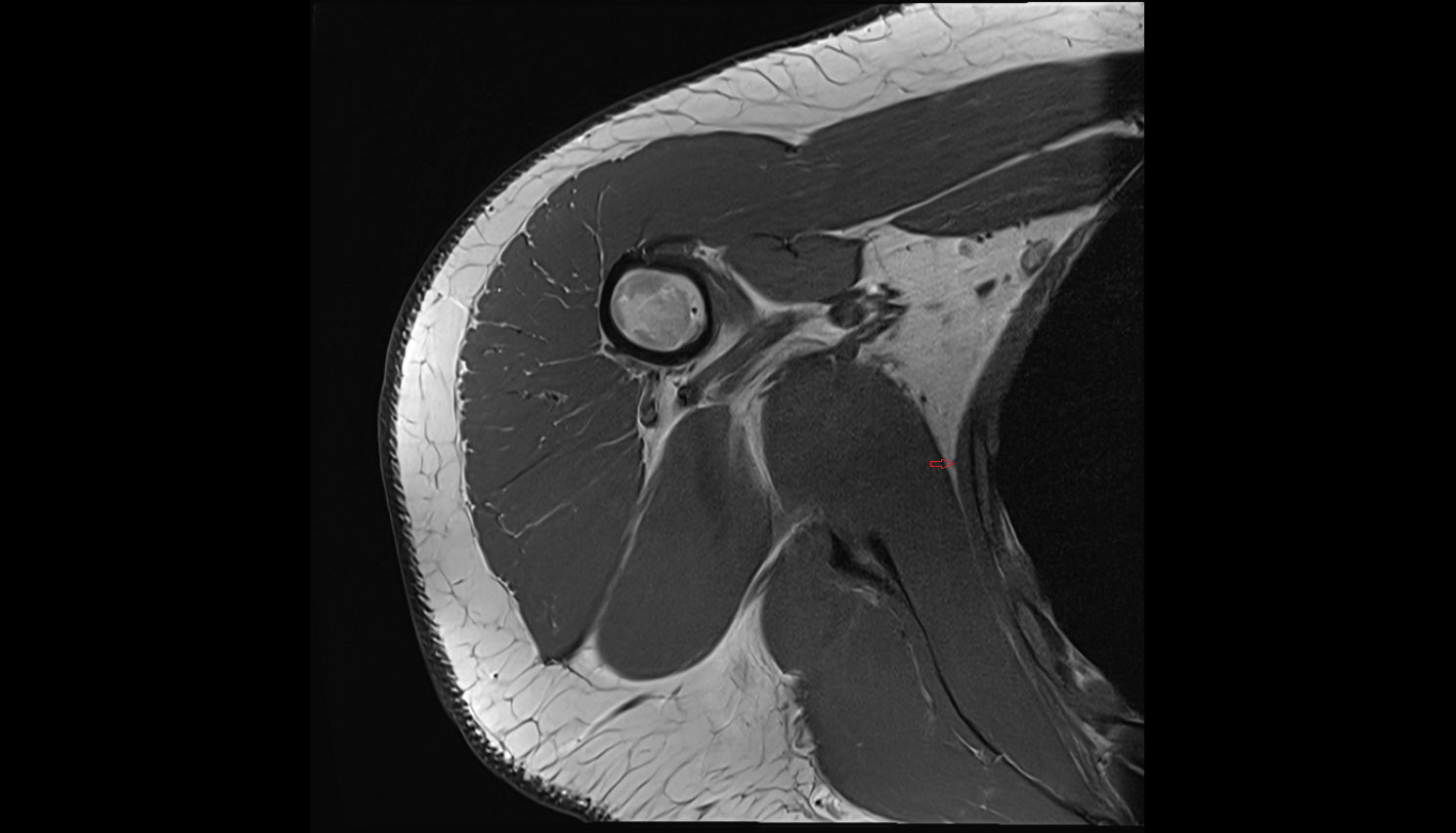 Long thoracic nerve axial cross sectional anatomy 3T MRI AI enhanced radiology image-img-00000-00000_00002
