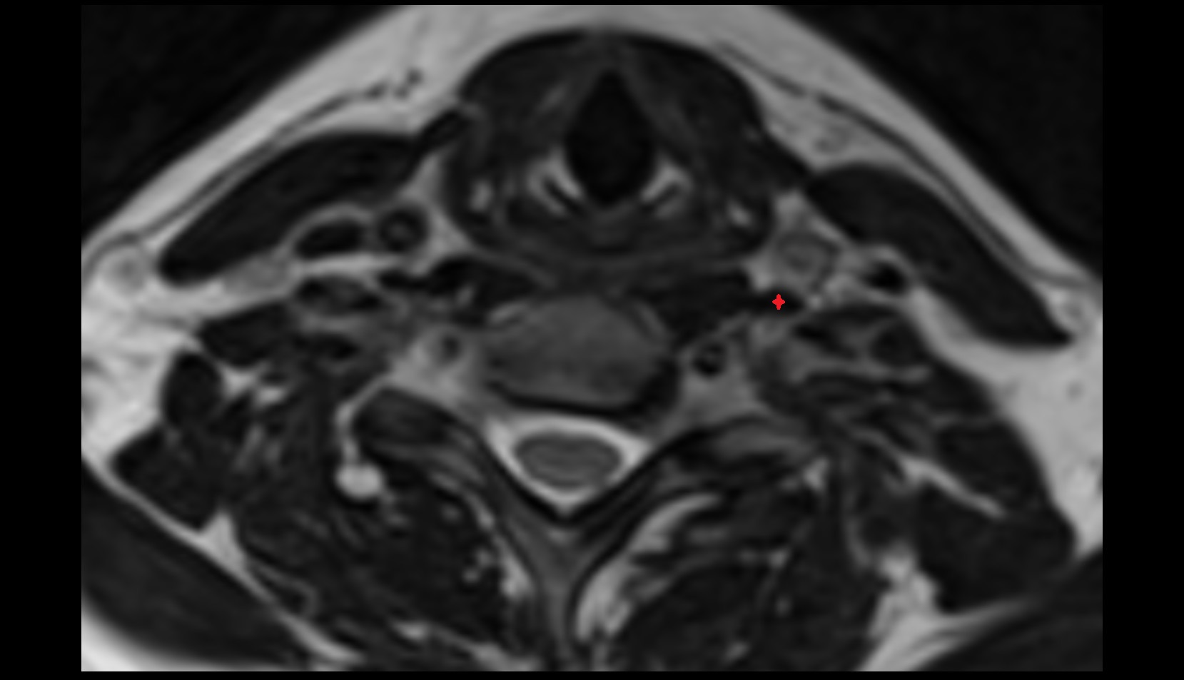 Longus capitis muscle axial mri image