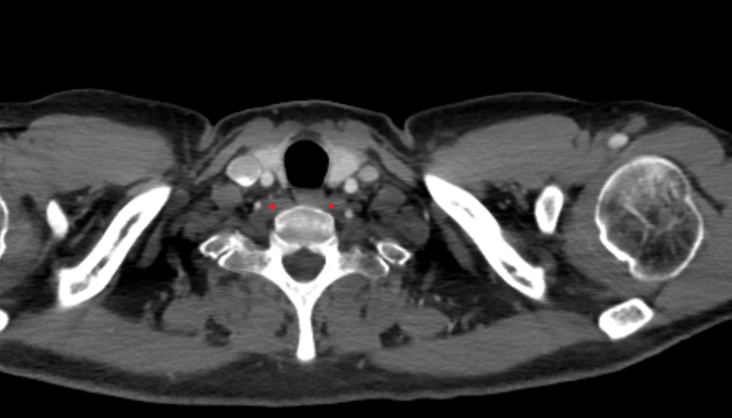 Longus colli muscle  anatomy ct axial  image -img-00000-00000