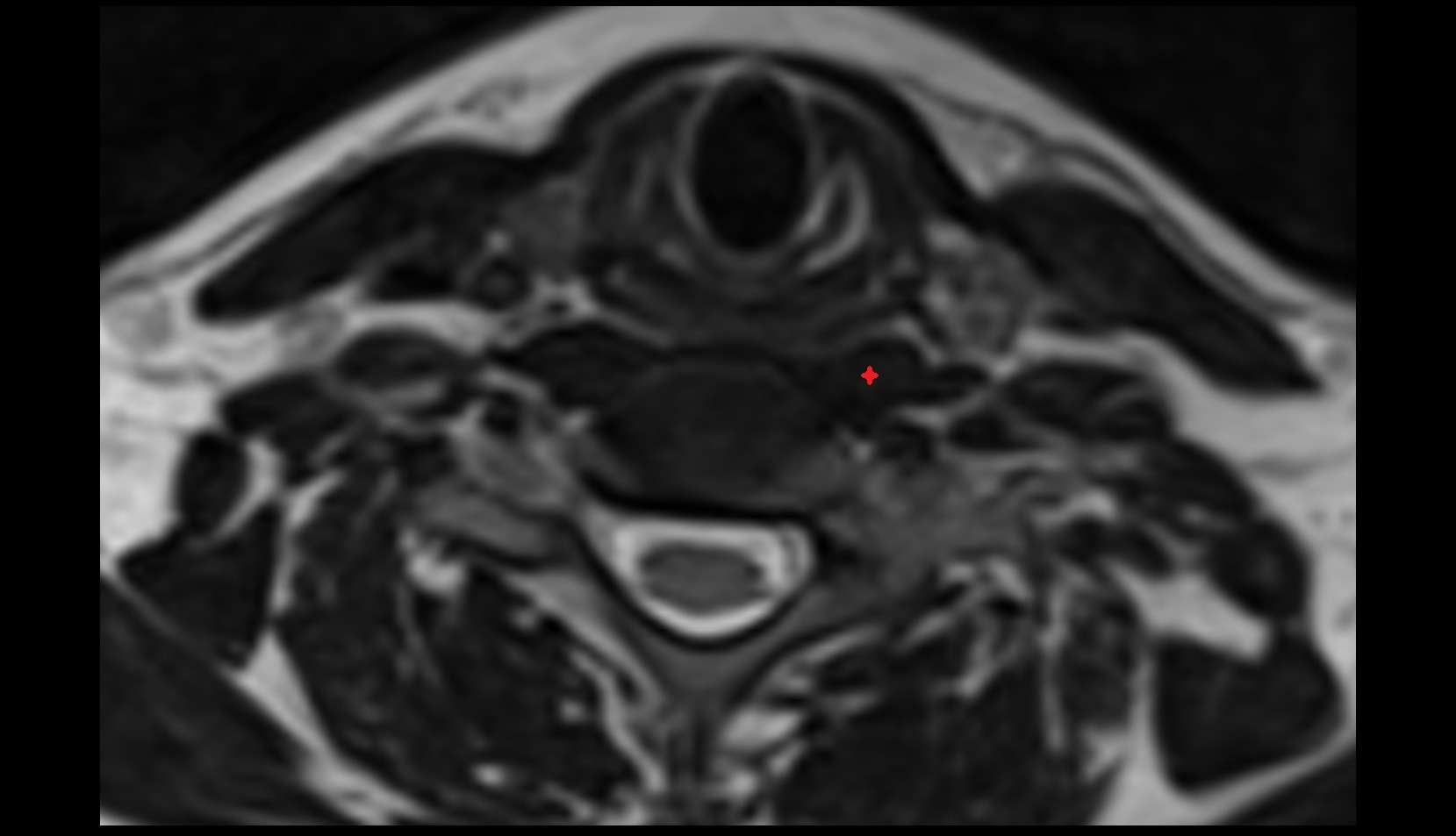 Longus colli muscle mri axial image