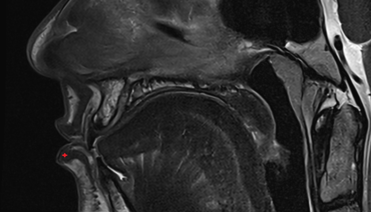 Lower lip mri image -img-00000-00000