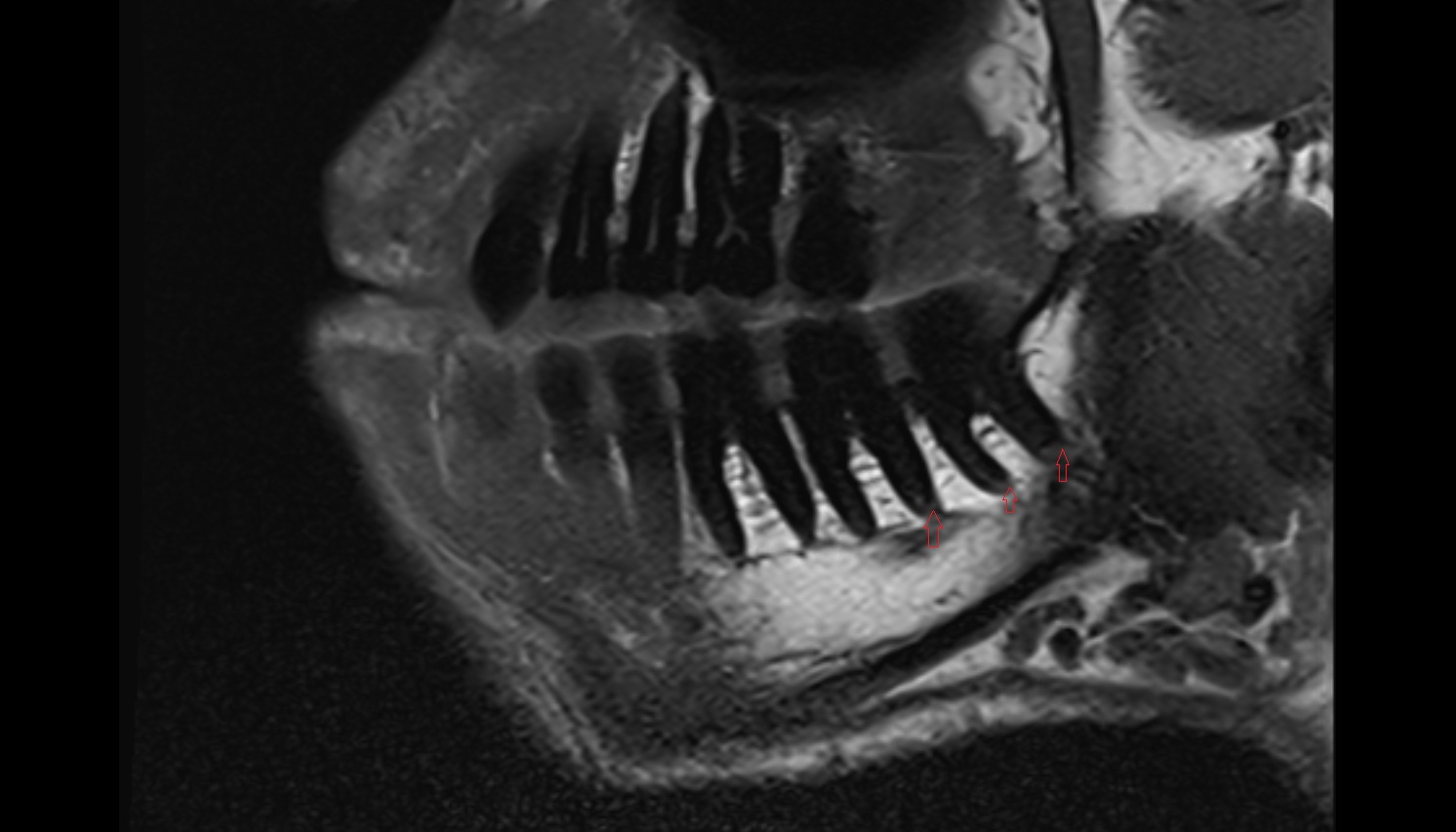 Lower molar apical foramen   mri sagittal  image -img-00000-00000