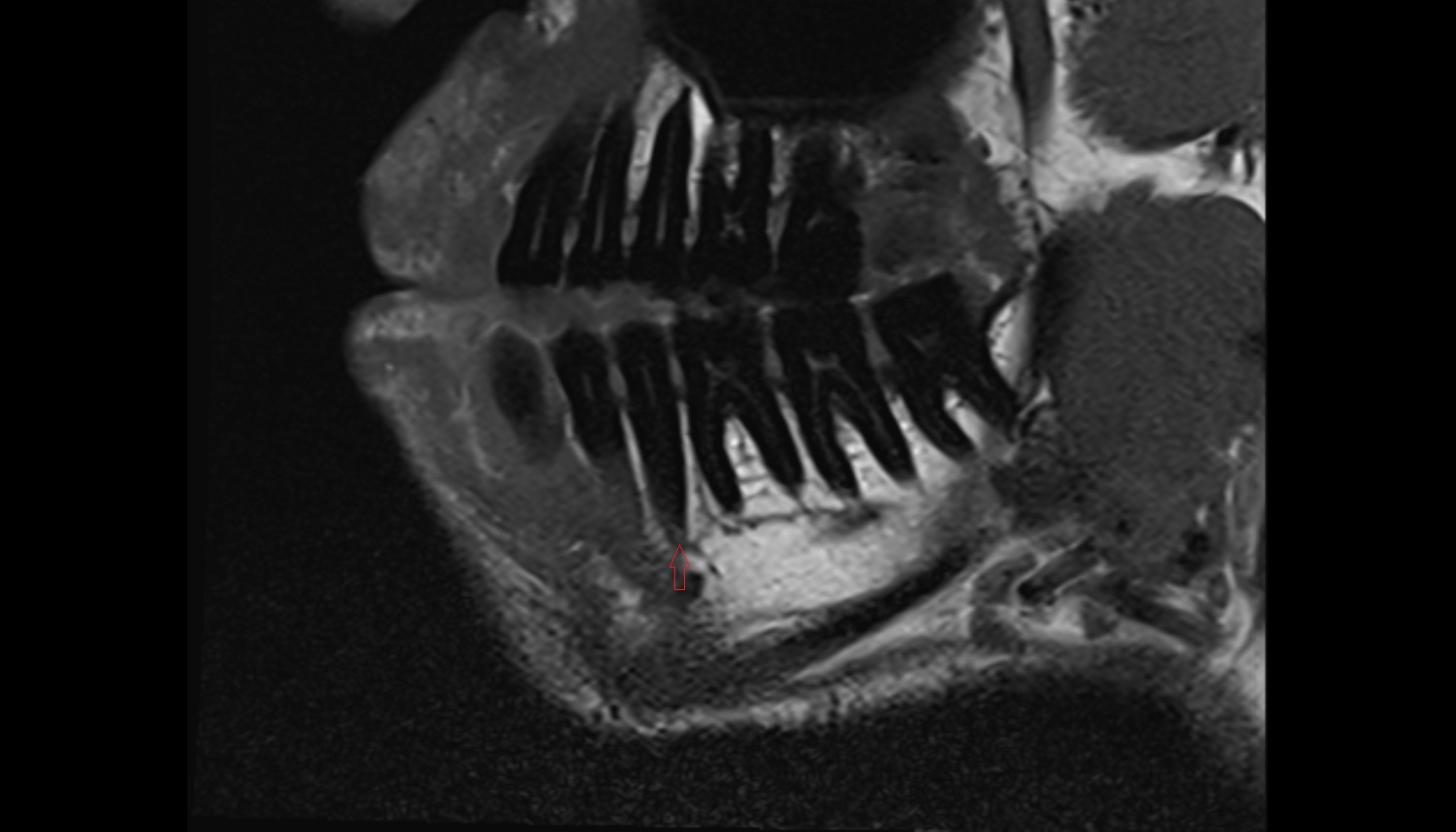 Lower premolar apical foramen  mri sagittal  image -img-00000-00000