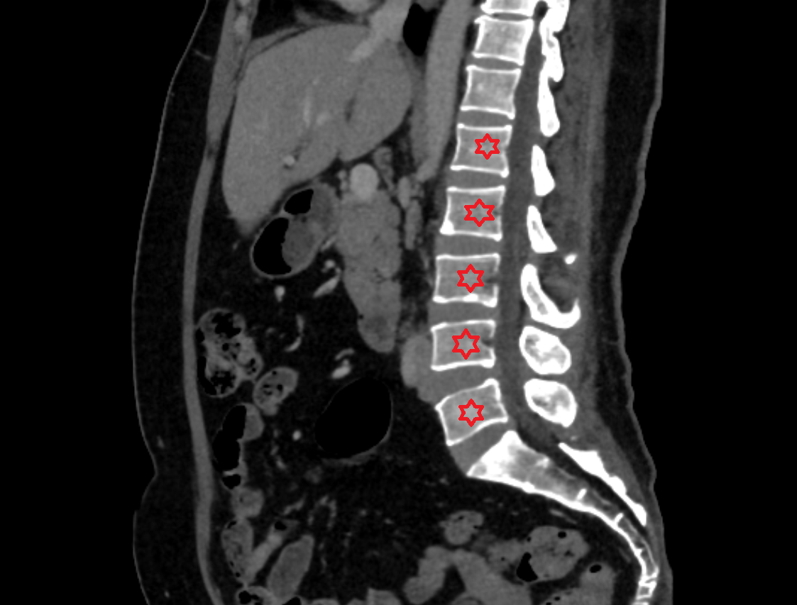 Lumbar spine CT SAG  anatomy  Location and Imaging Appearance  -img-00000-00000