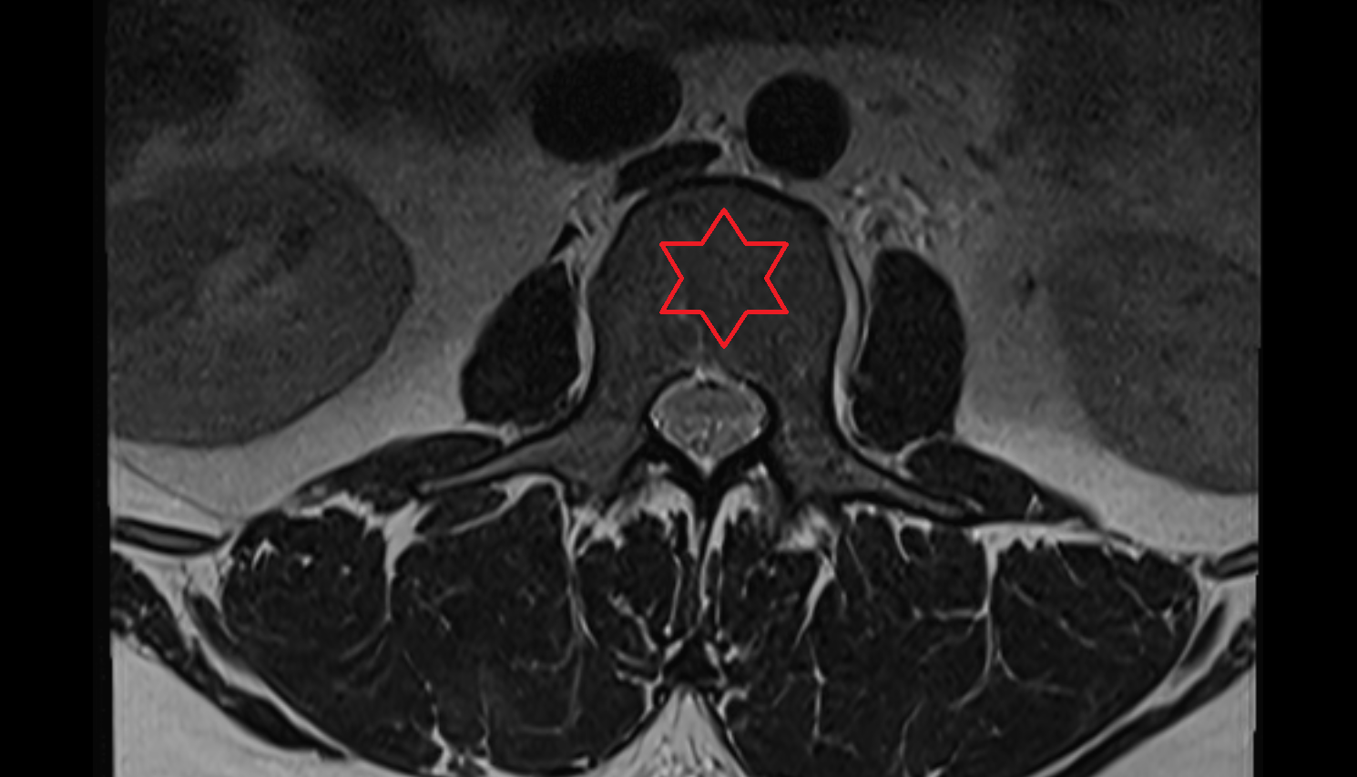 Lumbar spine mri axial  anatomy  Location and Imaging Appearance  -img-00000-00000