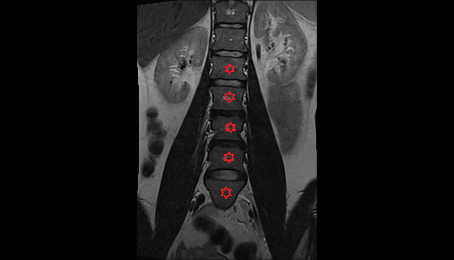 Lumbar spine mri coronal  anatomy  Location and Imaging Appearance  -img-00000-00000