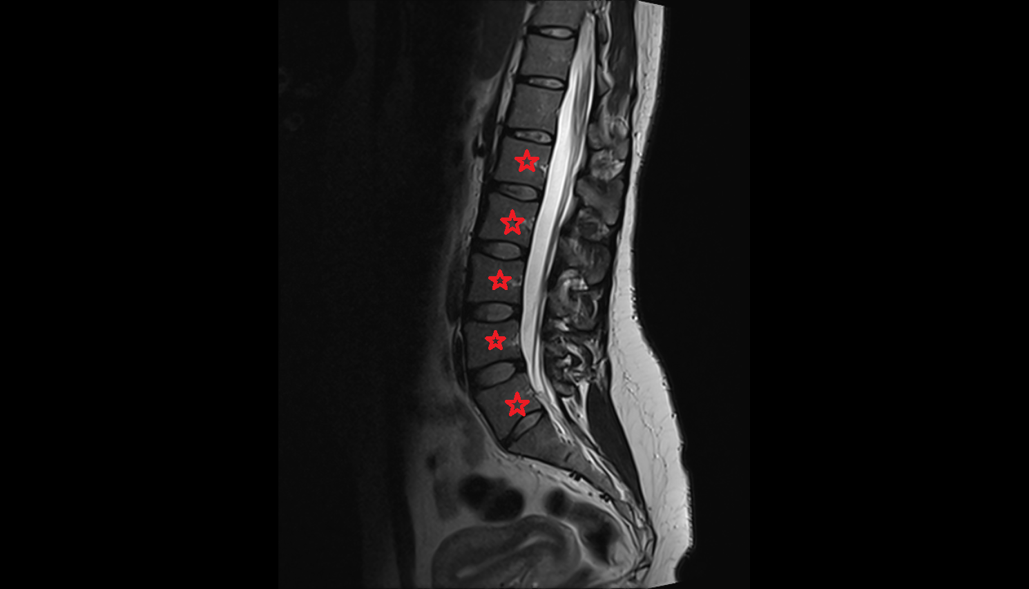 Lumbar spine mri sagittal  anatomy  Location and Imaging Appearance  -img-00000-00000