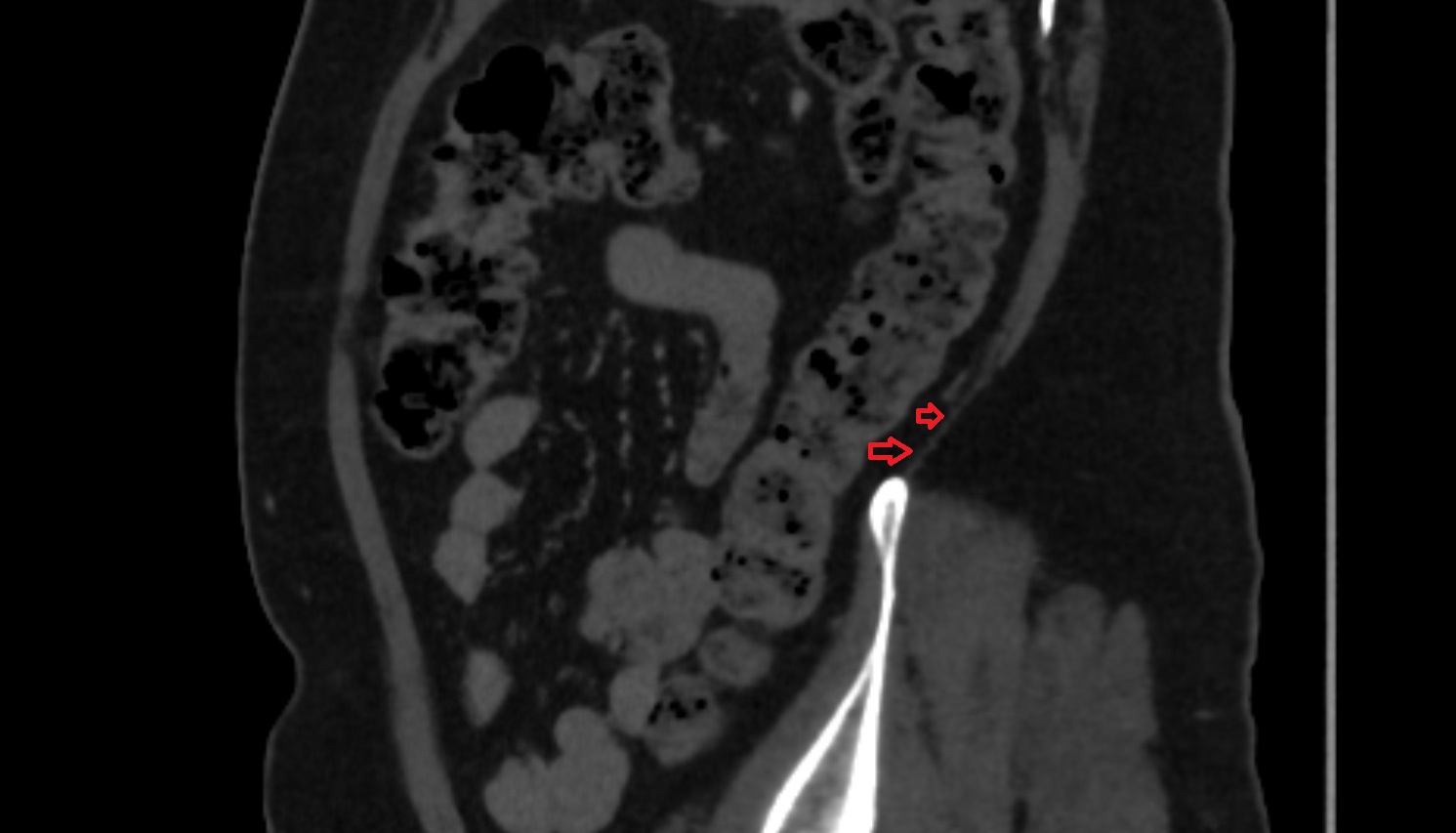 Lumbar triangle  CT sagittal  anatomy  image-img-00000-00000