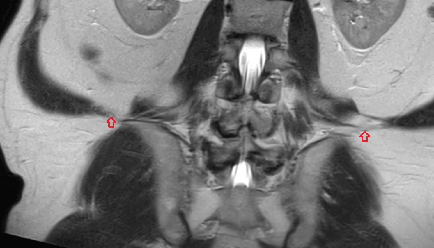 Lumbar triangle MRI coronal  anatomy  image-img-00000-00000
