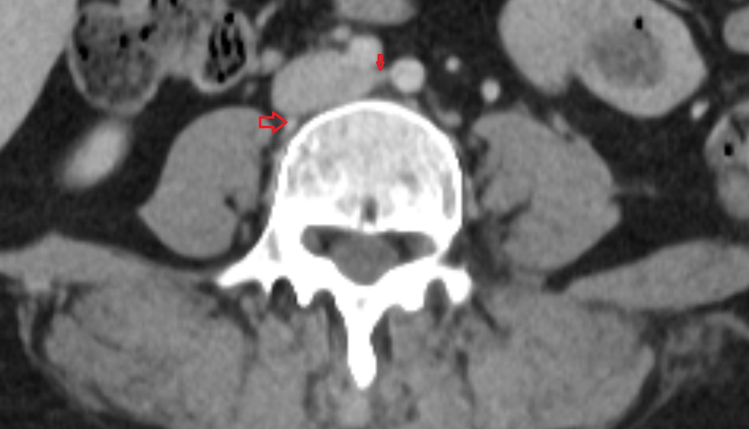 Lumbar vein CT  AXIAL anatomy  image-img-00000-00000