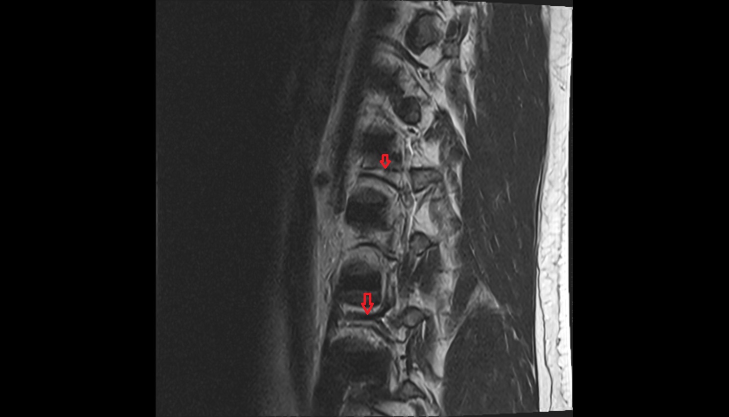 Lumbar vein  MRI AGITTAL  anatomy  image-img-00000-00000