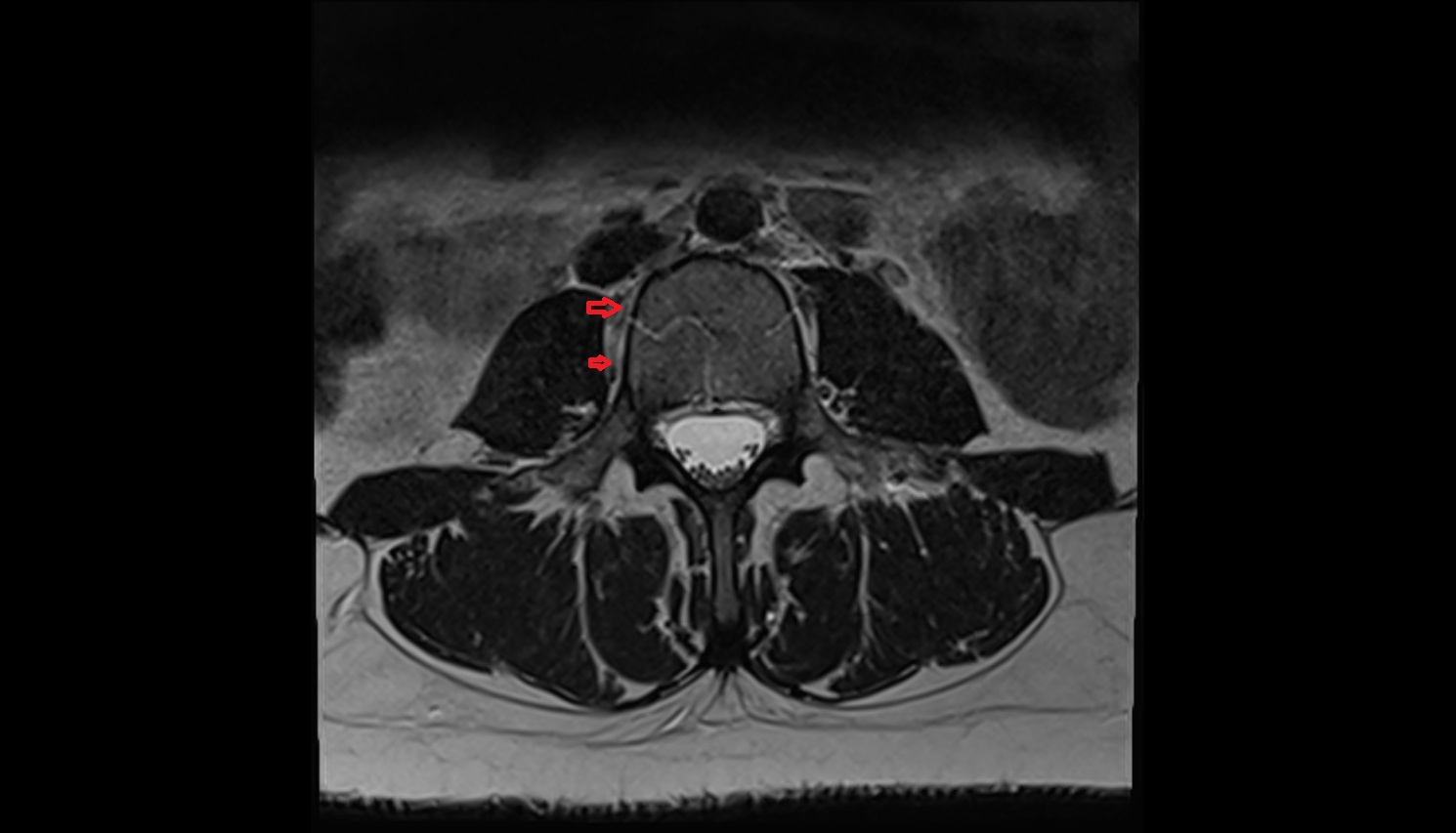 Lumbar vein  MRI AXIAL anatomy  image-img-00000-00000