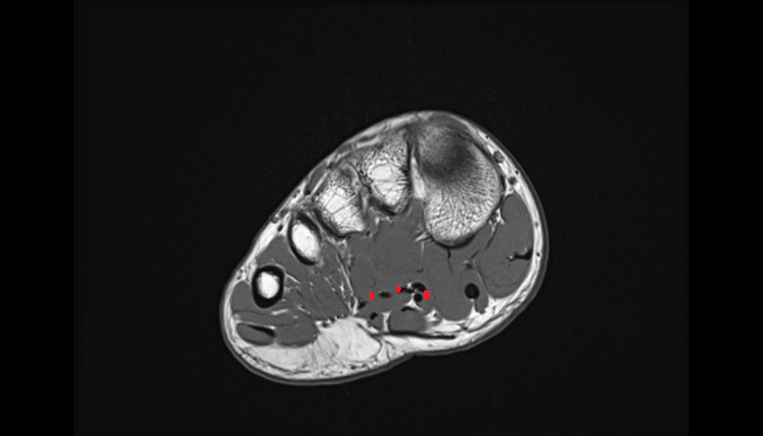 Lumbrical muscles axial cross sectional anatomy 3T MRI AI enhanced radiology image-img-00000-00000