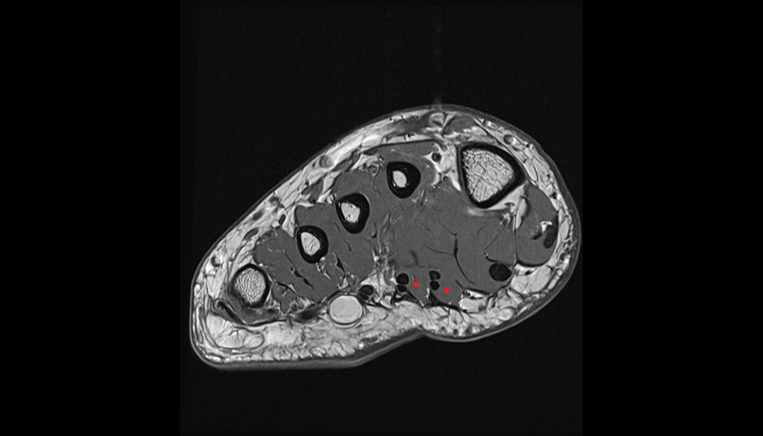 Lumbrical muscles axial cross sectional anatomy 3T MRI AI enhanced radiology image-img-00000-00000_00002