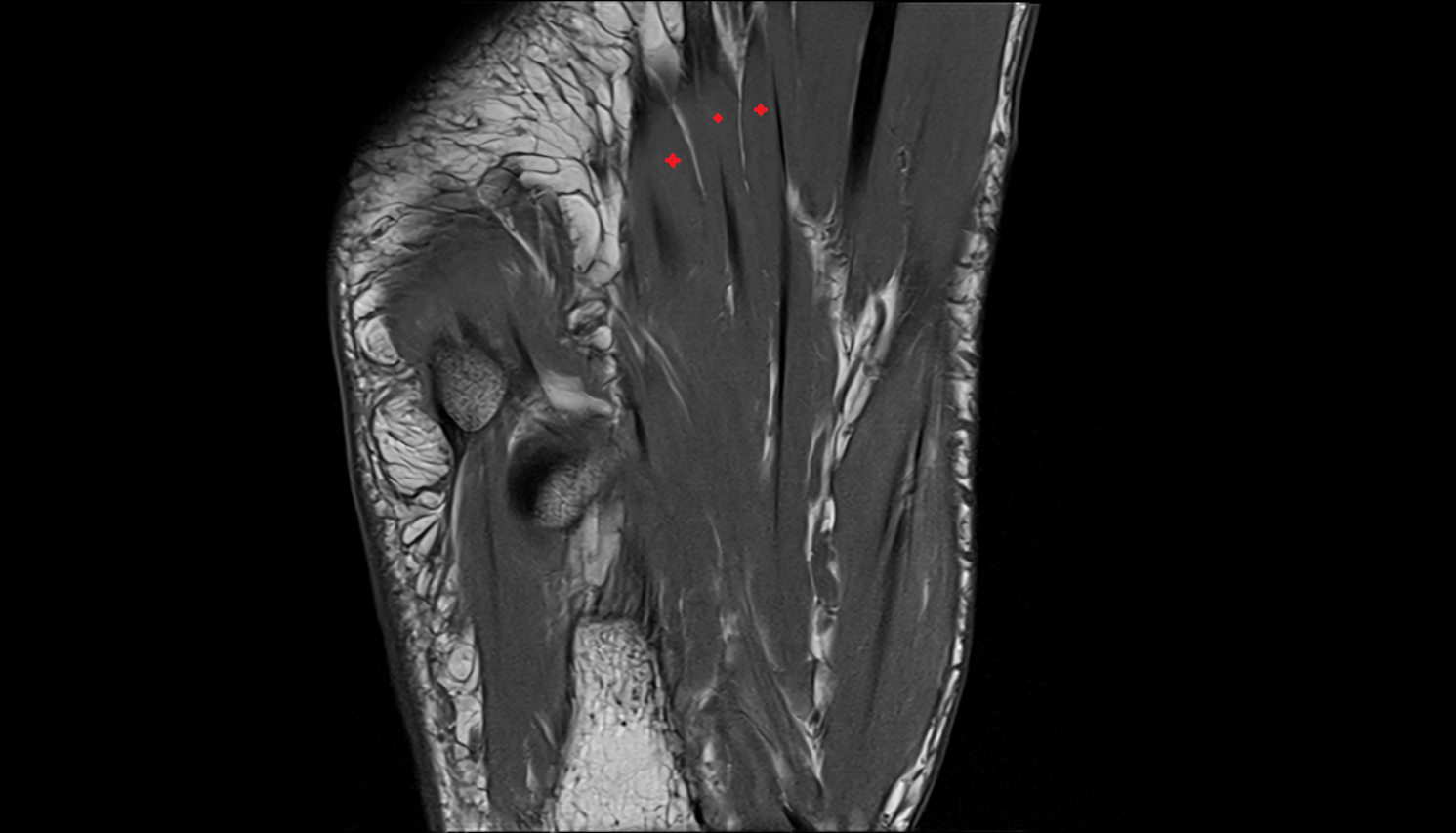 Lumbrical muscles axial cross sectional anatomy 3T MRI AI enhanced radiology image-img-00000-00000_00003