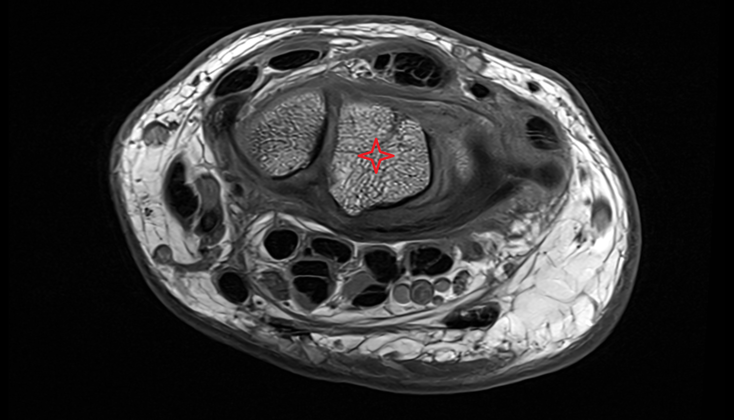 Lunate axial cross sectional anatomy 3T MRI AI enhanced radiology image-img-00000-00000_00001