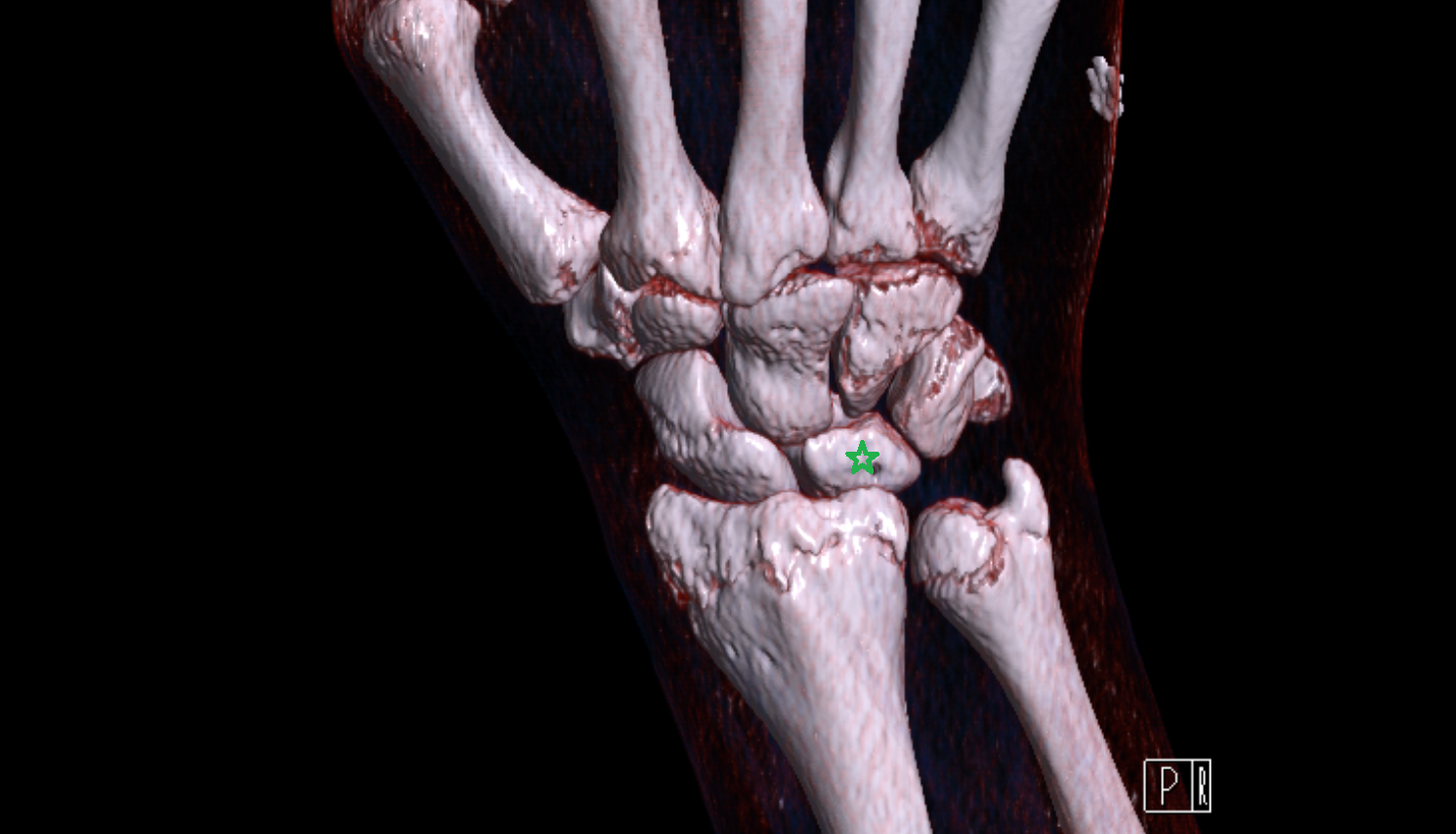Lunate bone CT 3D VRT image -img-00000-00000