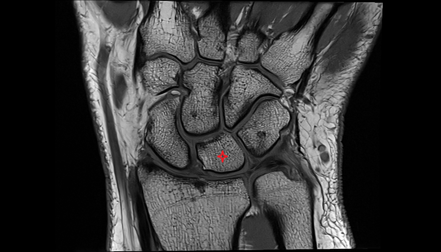 Lunate coronal cross sectional anatomy 3T MRI AI enhanced radiology image-img-00000-00000