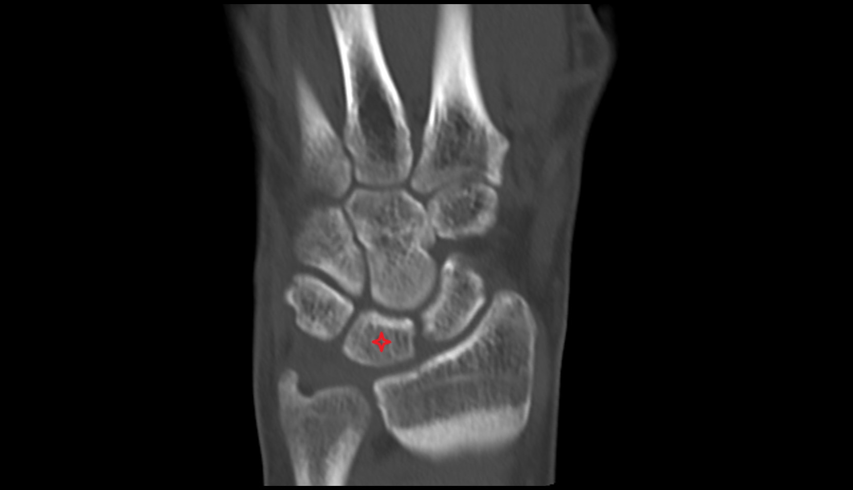 Lunate ct coronal image