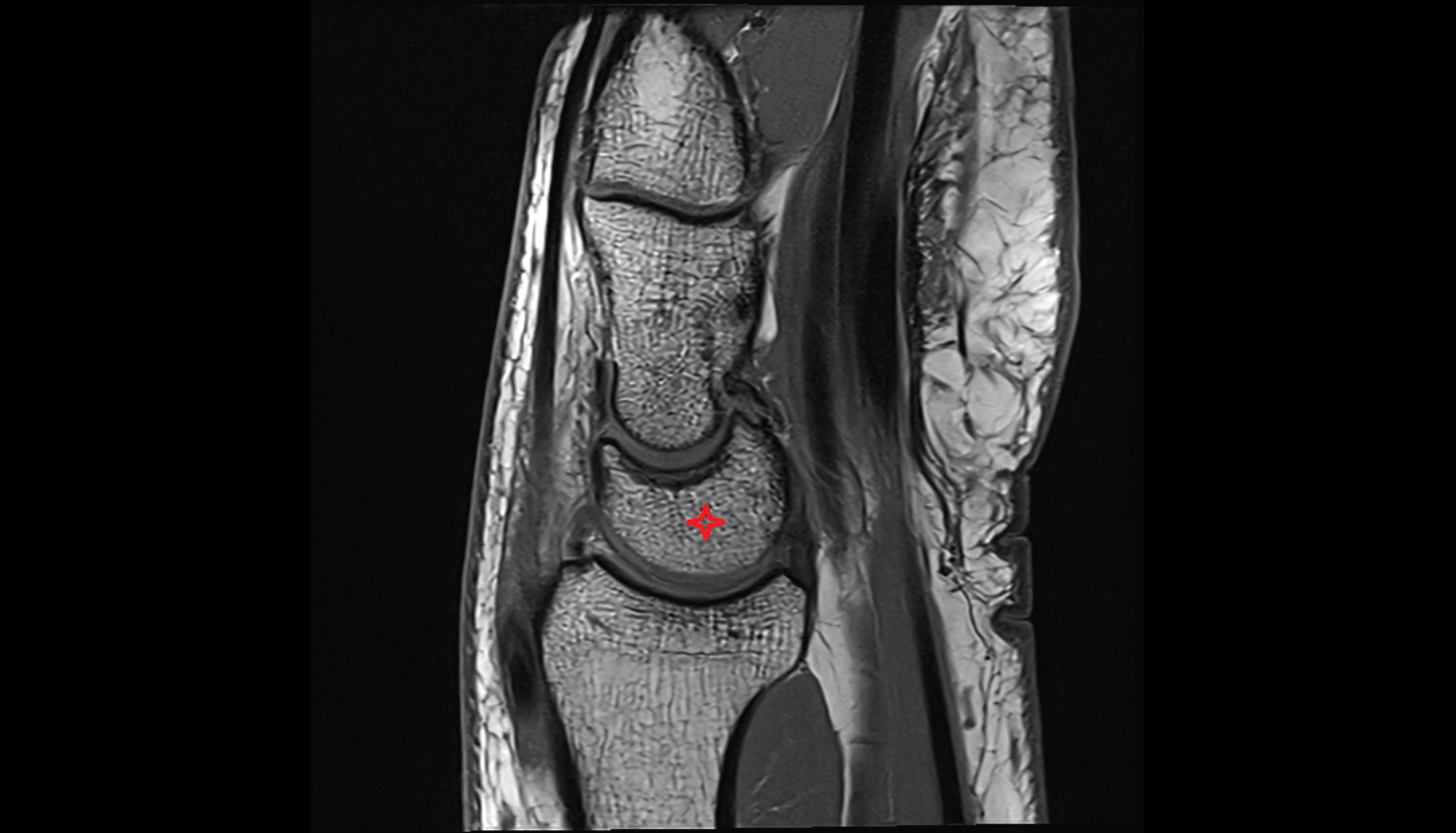 Lunate sag cross sectional anatomy 3T MRI AI enhanced radiology image-img-00000-00000