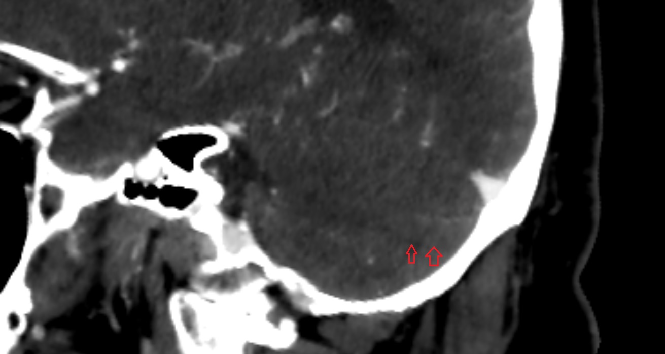 Lunogracle fissure  CT sag  anatomy image -img-00001-00001