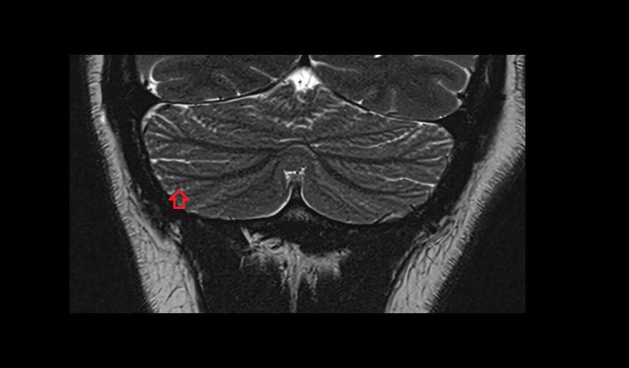 Lunogracle fissure MRI 3T coronal image