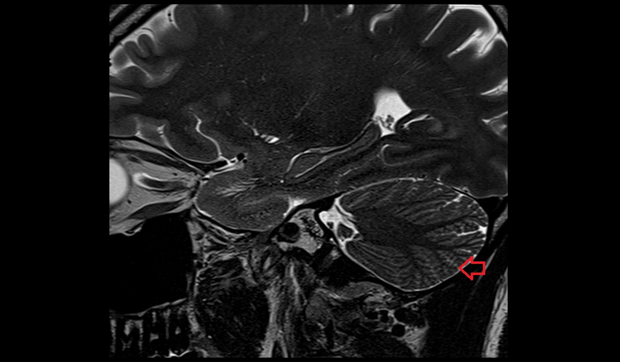 Lunogracle fissure MRI 3T sagittal image