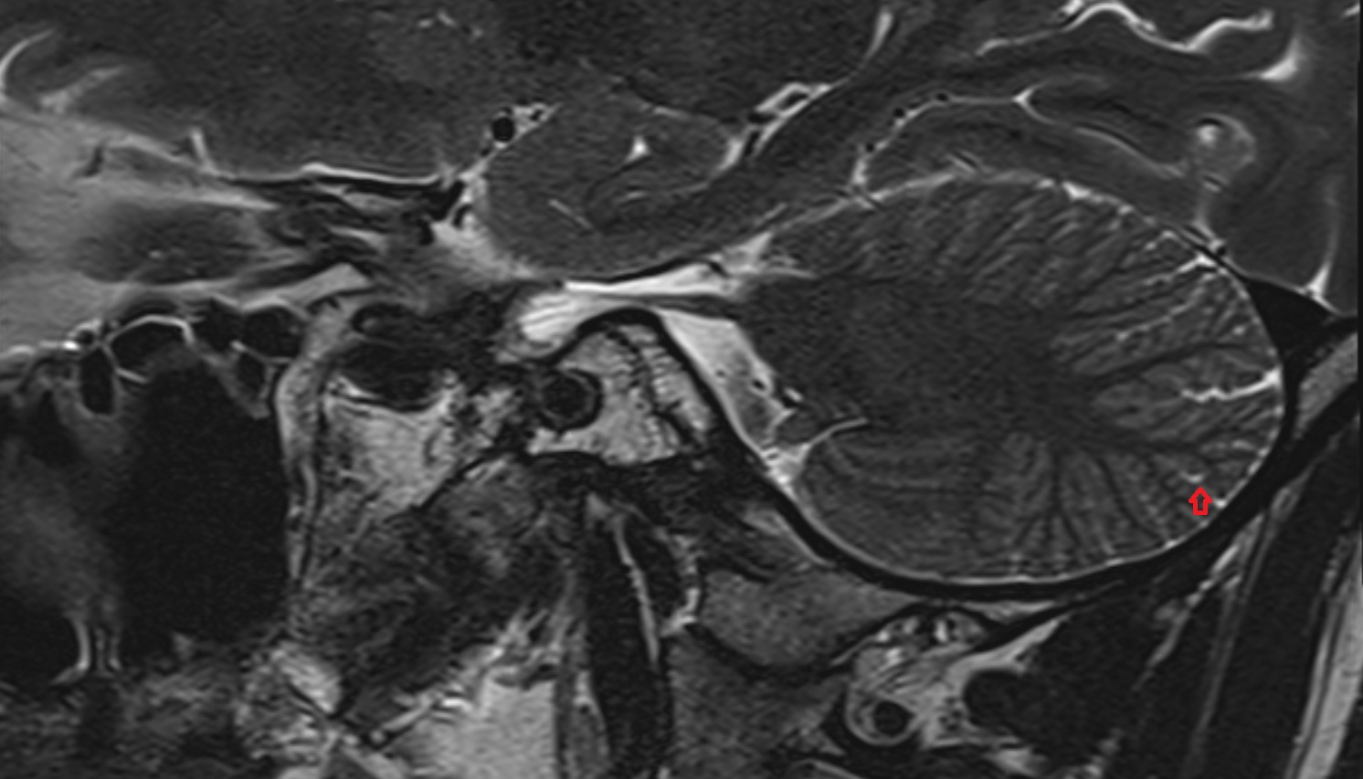 Lunogranicile fissure of Cerebellum  mri sag  image -img-00000-00000