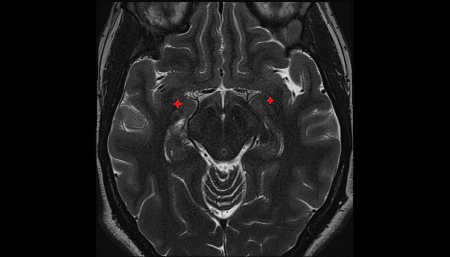 MRI Amygdaloclaustral area axial anatomy image -img-00000-00000