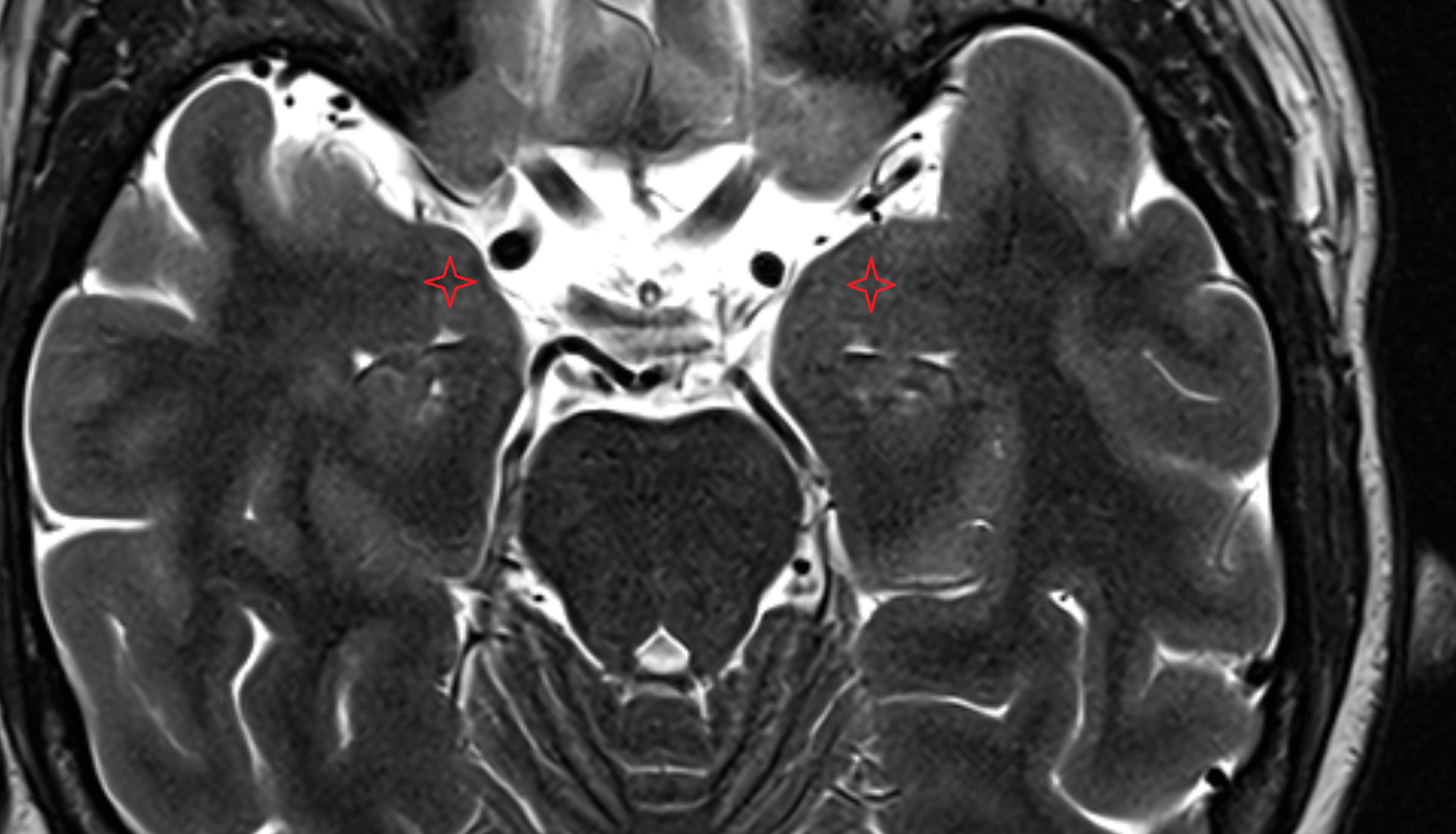MRI Amygdalohippocampal area axial anatomy image -img-00000-00000