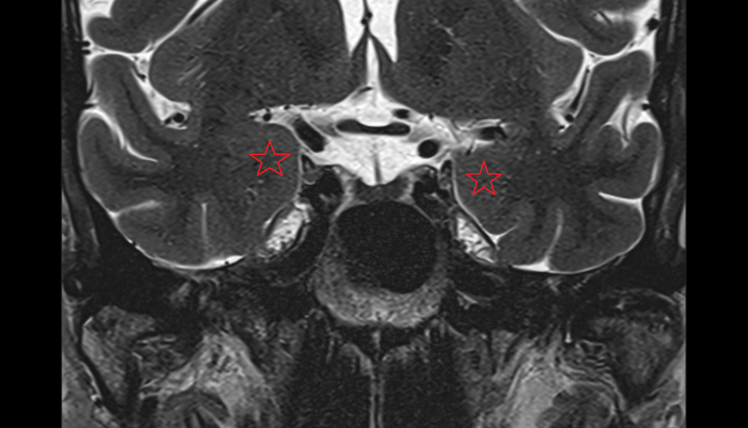 MRI Amygdalohippocampal area coronal anatomy image -img-00000-00000