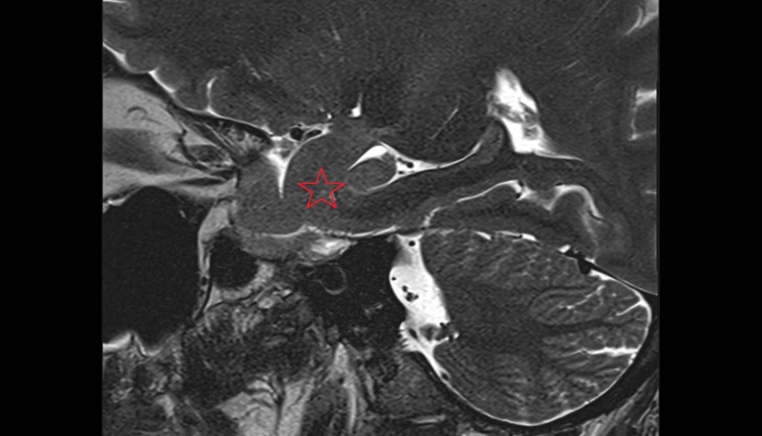 MRI Amygdalohippocampal area sagittal anatomy image -img-00000-00000