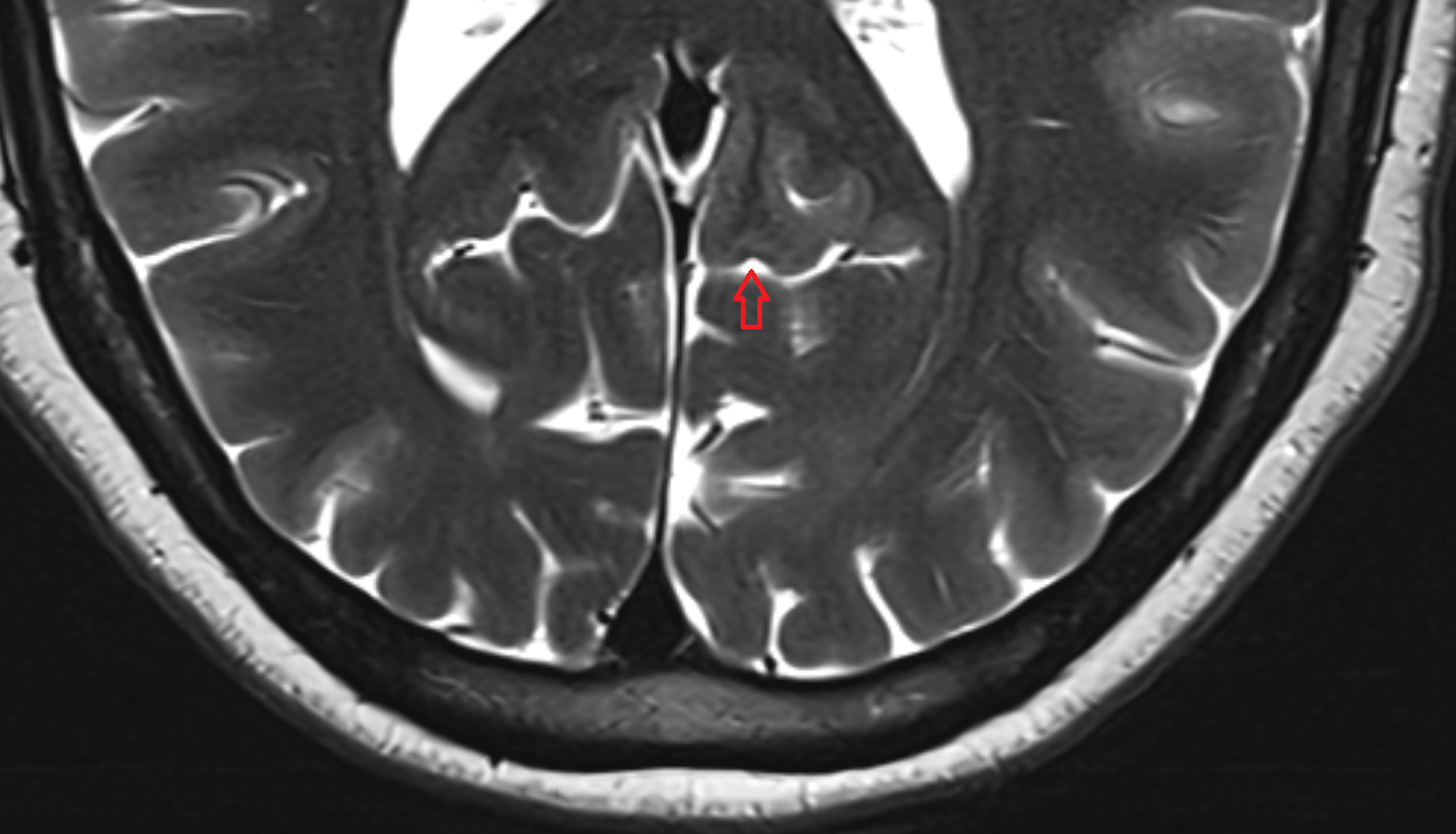 MRIAnterior calcarine sulcus  axial anatomy image -img-00000-00000