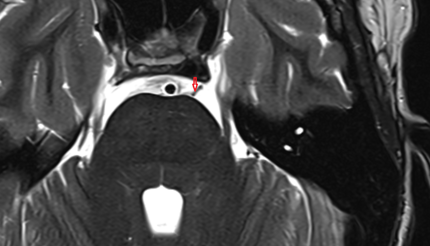 MRI Anterolateral pontine vein axial anatomy image -img-00000-00000