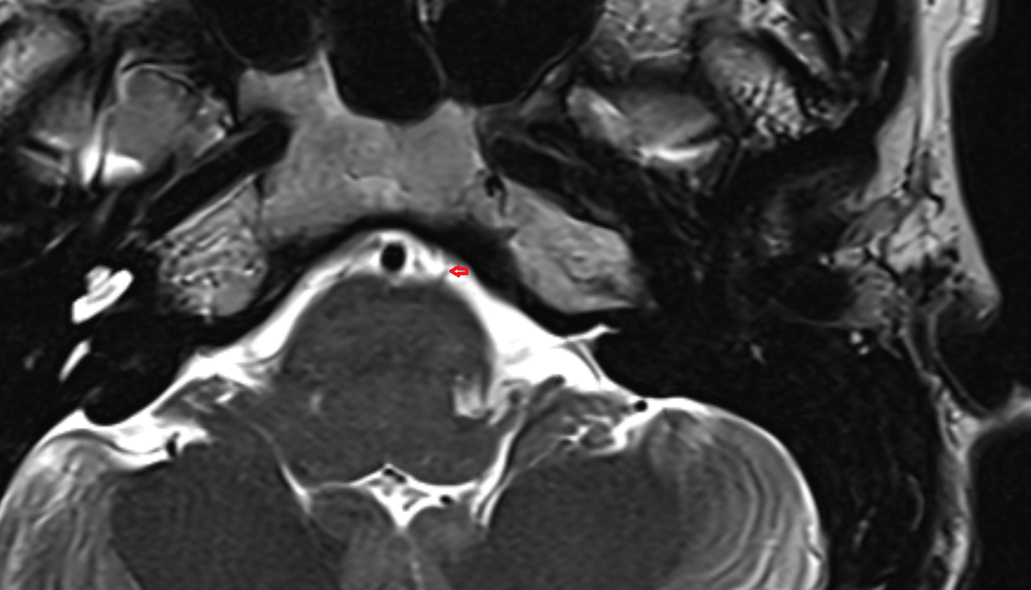 MRI Anterolateral pontine vein axial anatomy image -img-00000-00000_00001