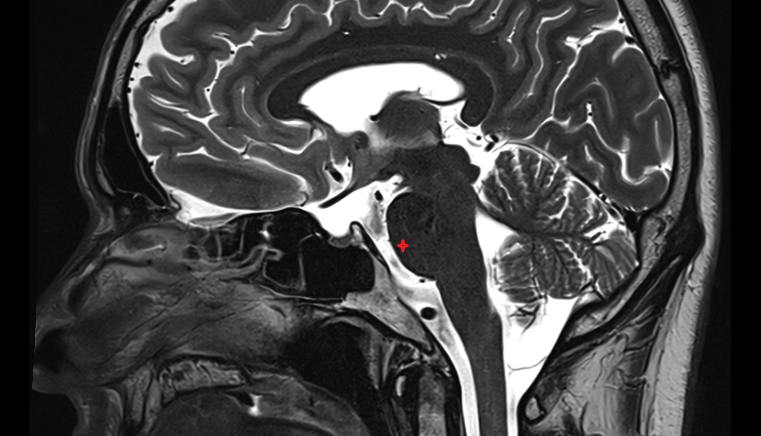 MRI Basilar part of pons anatomy image -img-00000-00000